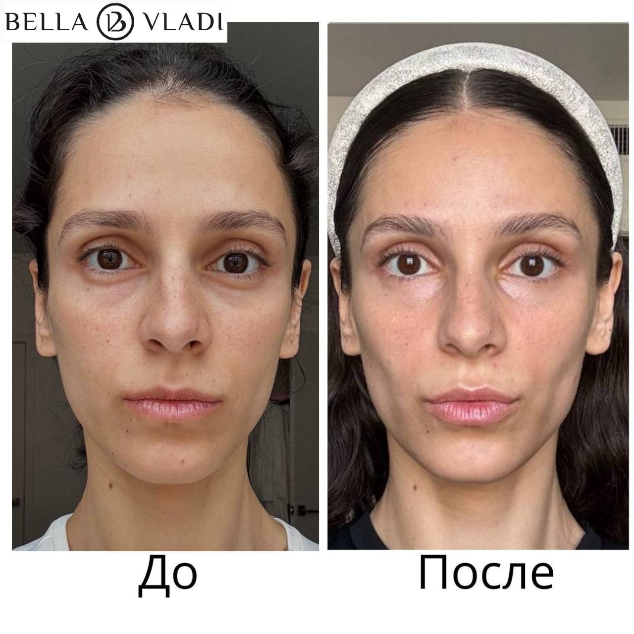Результат ученицы Беллы Влади до и после практики ФейсФитнес, анфас